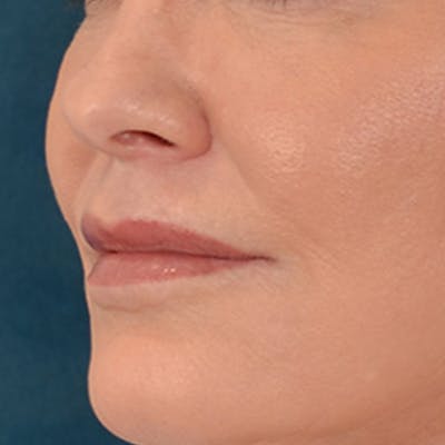 Lip Lift Before & After Gallery - Patient 276256 - Image 8