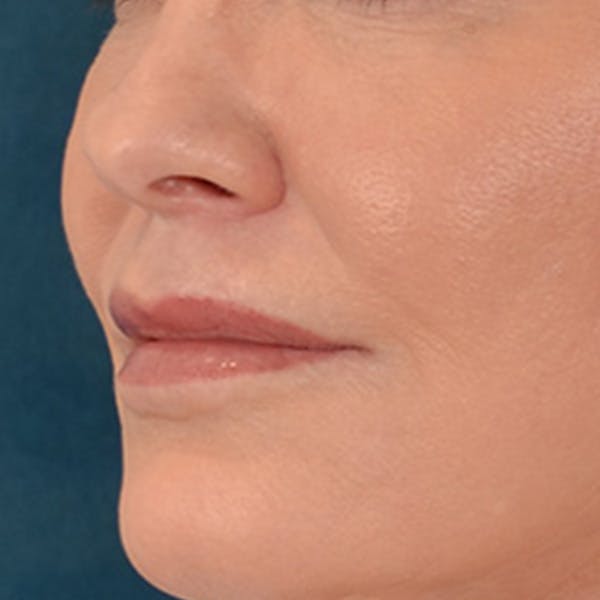Lip Lift Before & After Gallery - Patient 276256 - Image 8