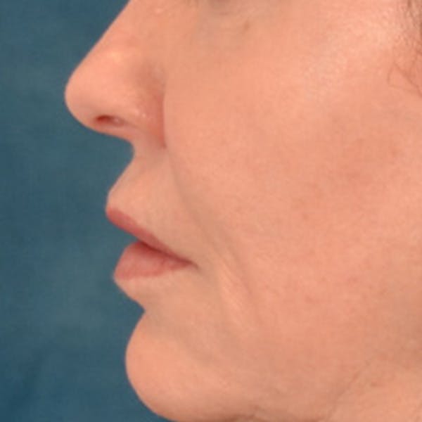 Lip Lift Before & After Gallery - Patient 276256 - Image 9