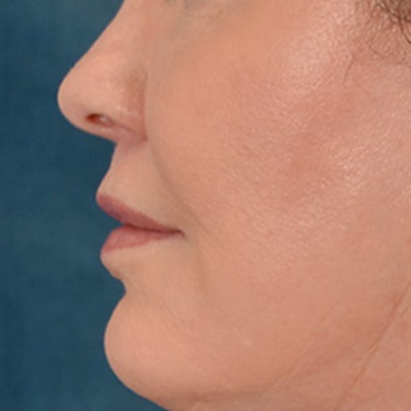 Lip Lift Before & After Gallery - Patient 276256 - Image 10