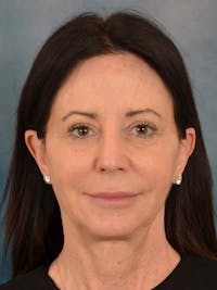 Fat Transfer Before & After Gallery - Patient 353451 - Image 1