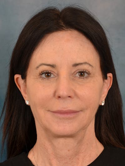 Fat Transfer Before & After Gallery - Patient 353451 - Image 1