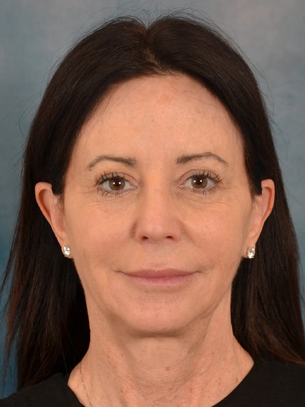 Fat Transfer Before & After Gallery - Patient 353451 - Image 1