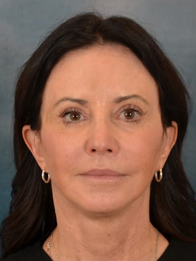 Fat Transfer Before & After Gallery - Patient 353451 - Image 2