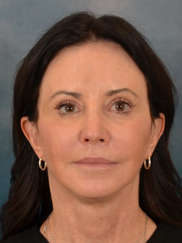 Fat Transfer Before & After Gallery - Patient 353451 - Image 2