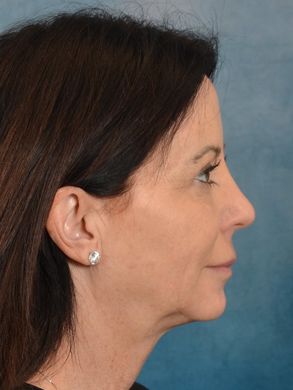 Fat Transfer Before & After Gallery - Patient 353451 - Image 5