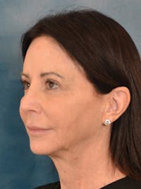 Deep Plane Facelift Before & After Gallery - Patient 148969 - Image 1