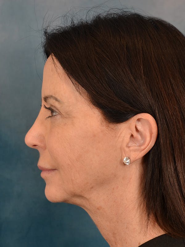 Fat Transfer Before & After Gallery - Patient 353451 - Image 9