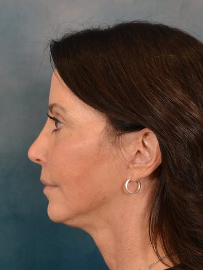 Fat Transfer Before & After Gallery - Patient 353451 - Image 10