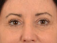 Eyelid Lift Before & After Gallery - Patient 843051 - Image 1