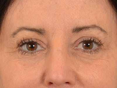 Eyelid Lift Before & After Gallery - Patient 843051 - Image 1