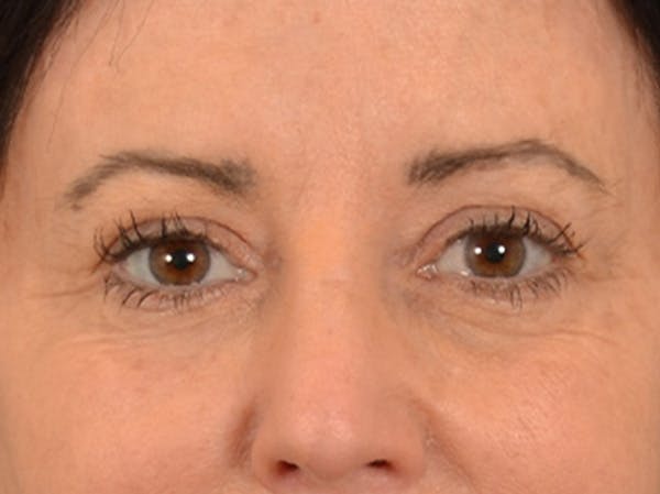 Eyelid Lift Before & After Gallery - Patient 843051 - Image 1