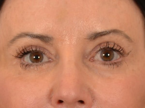 Eyelid Lift Before & After Gallery - Patient 843051 - Image 2