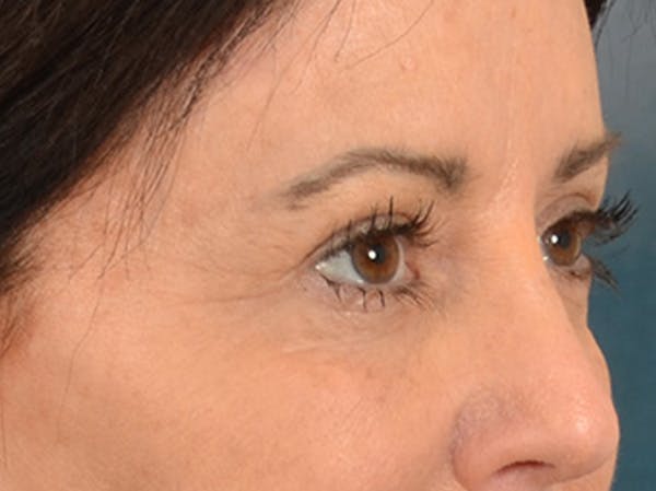Eyelid Lift Before & After Gallery - Patient 843051 - Image 3