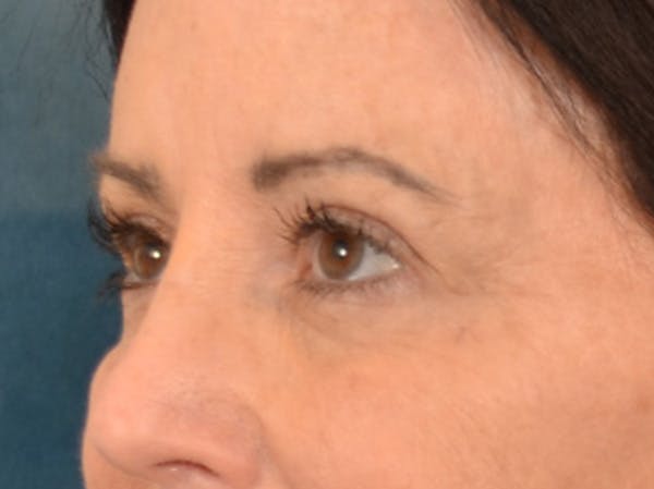 Eyelid Lift Before & After Gallery - Patient 843051 - Image 7