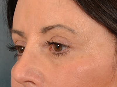 Eyelid Lift Before & After Gallery - Patient 843051 - Image 8