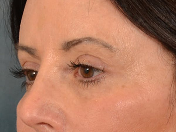 Eyelid Lift Before & After Gallery - Patient 843051 - Image 8