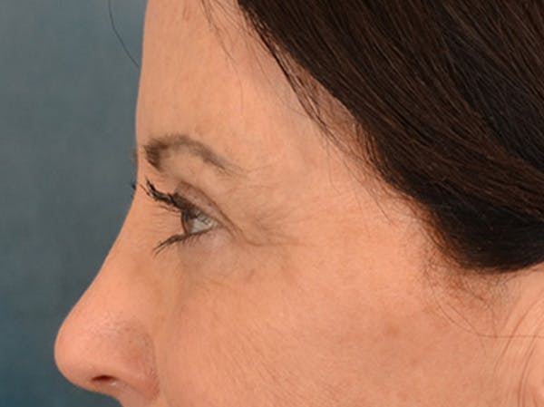 Eyelid Lift Before & After Gallery - Patient 843051 - Image 9
