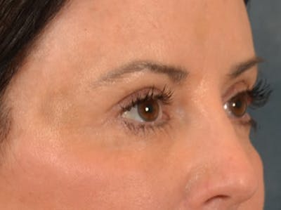 Eyelid Lift Before & After Gallery - Patient 843051 - Image 4