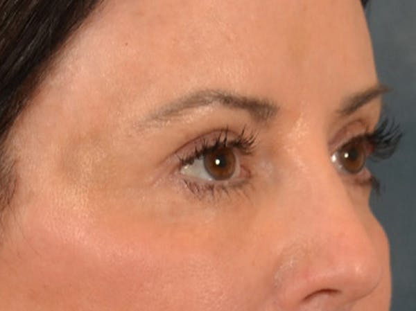 Eyelid Lift Before & After Gallery - Patient 843051 - Image 4