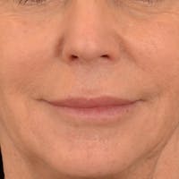 Lip Lift Before & After Gallery - Patient 570001 - Image 1