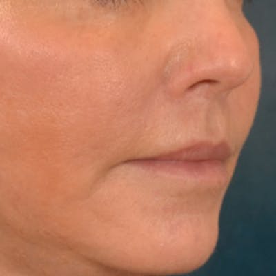 Lip Lift Before & After Gallery - Patient 570001 - Image 4