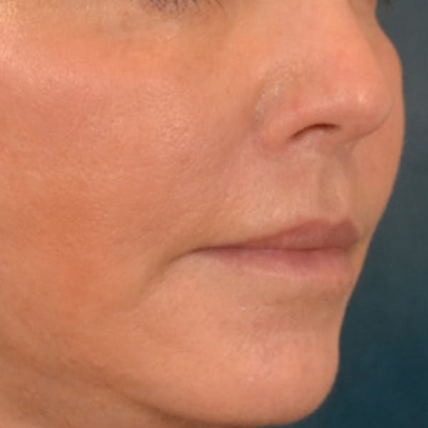 Lip Lift Before & After Gallery - Patient 570001 - Image 4