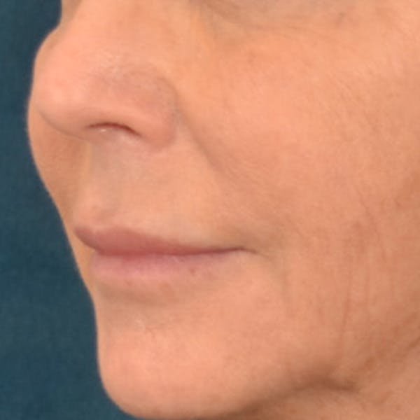 Lip Lift Before & After Gallery - Patient 570001 - Image 7