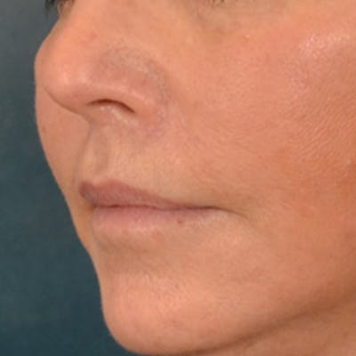 Lip Lift Before & After Gallery - Patient 570001 - Image 8