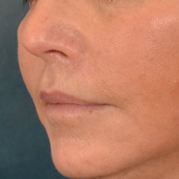 Lip Lift Before & After Gallery - Patient 570001 - Image 8