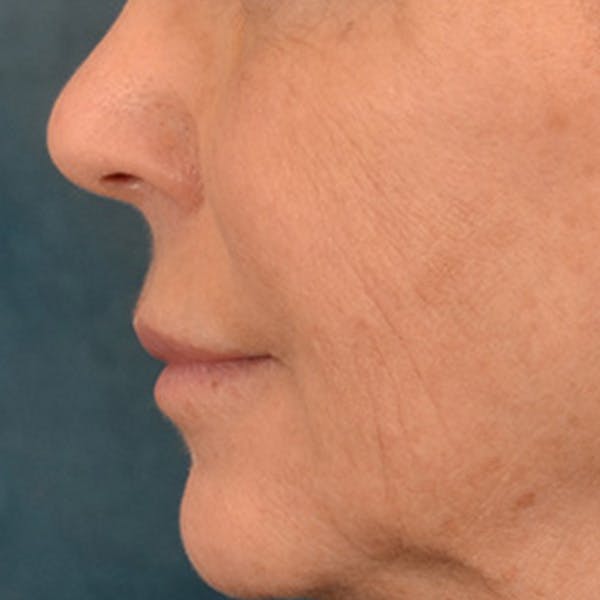 Lip Lift Before & After Gallery - Patient 570001 - Image 9