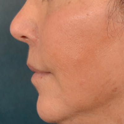 Lip Lift Before & After Gallery - Patient 570001 - Image 10