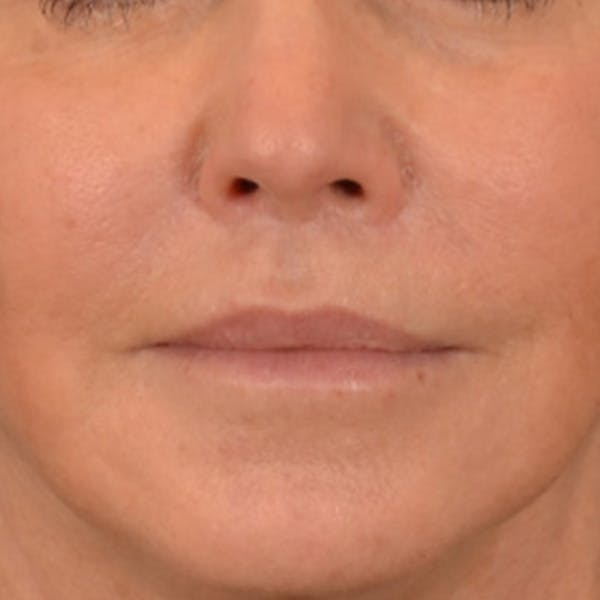 Lip Lift Before & After Gallery - Patient 570001 - Image 2
