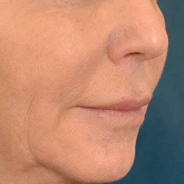 Lip Lift Before & After Gallery - Patient 570001 - Image 3