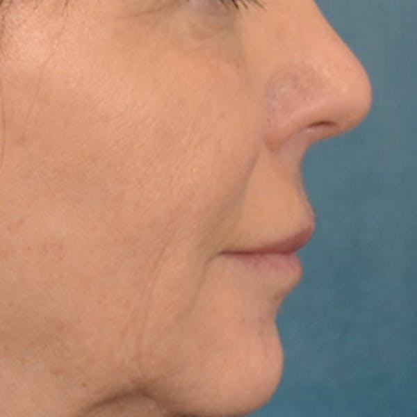 Lip Lift Before & After Gallery - Patient 570001 - Image 5