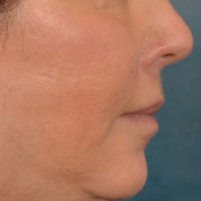 Lip Lift Before & After Gallery - Patient 570001 - Image 6