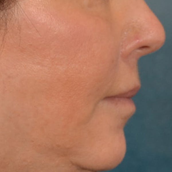 Lip Lift Before & After Gallery - Patient 570001 - Image 6