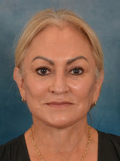 Deep Plane Facelift Before & After Gallery - Patient 211055 - Image 6