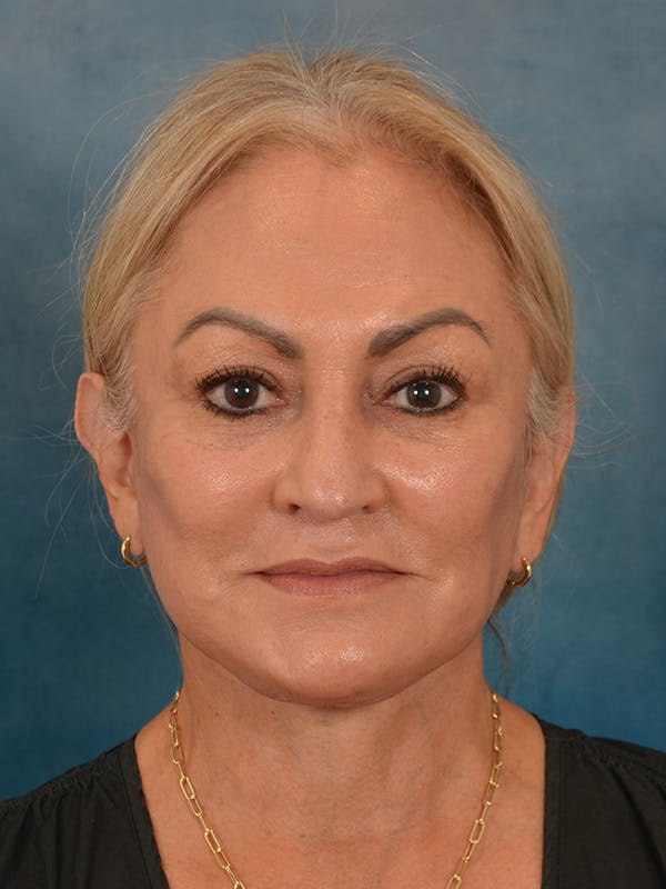 Deep Plane Facelift Before & After Gallery - Patient 211055 - Image 6