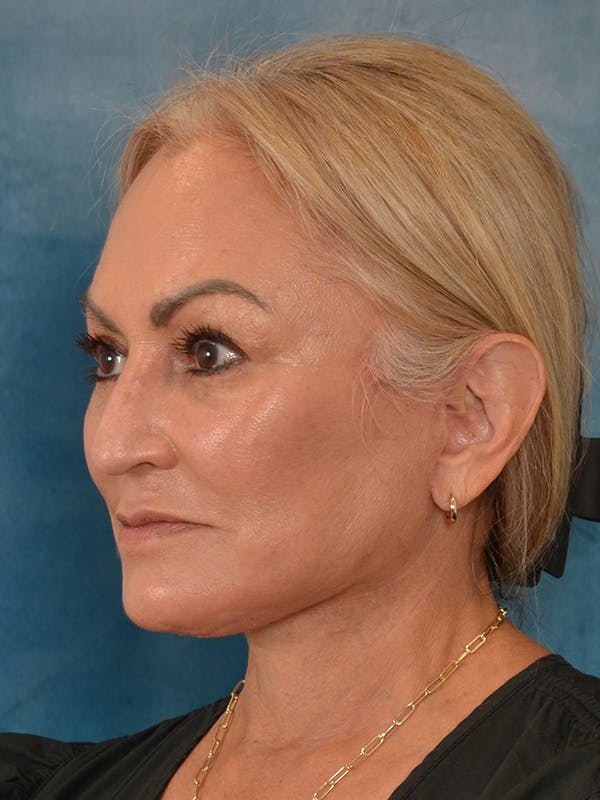 Deep Plane Facelift Before & After Gallery - Patient 211055 - Image 2