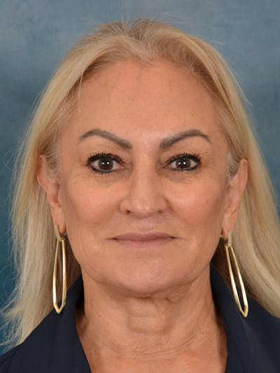 Deep Neck Lift Before & After Gallery - Patient 183283 - Image 1