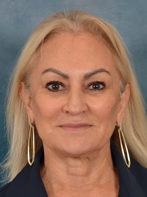 Deep Plane Facelift Before & After Gallery - Patient 211055 - Image 5