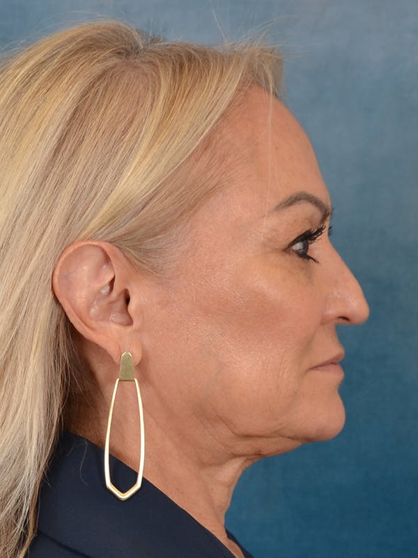 Deep Plane Facelift Before & After Gallery - Patient 211055 - Image 9