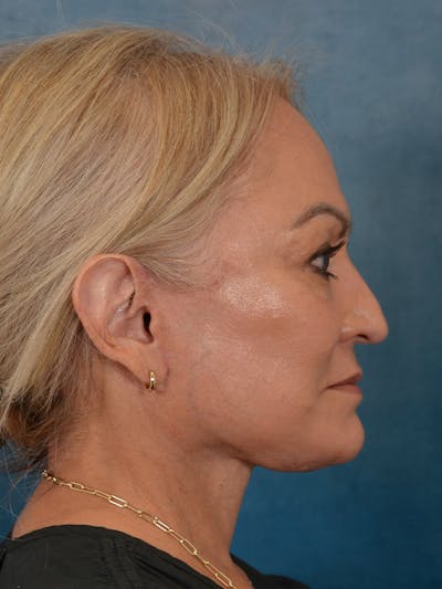 Deep Plane Facelift Before & After Gallery - Patient 211055 - Image 10