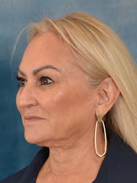 Deep Plane Facelift Before & After Gallery - Patient 211055 - Image 1