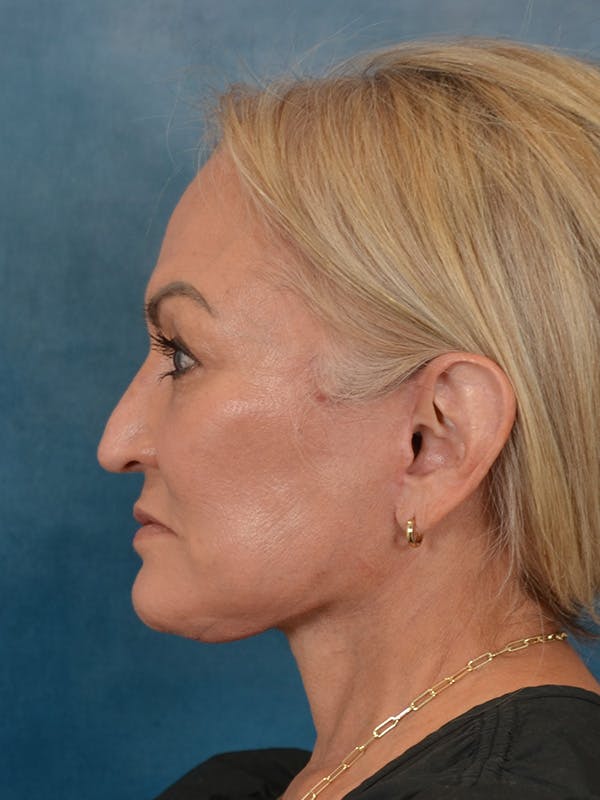 Deep Plane Facelift Before & After Gallery - Patient 211055 - Image 4