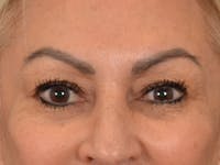 Eyelid Lift Before & After Gallery - Patient 430420 - Image 1