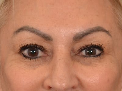 Eyelid Lift Before & After Gallery - Patient 430420 - Image 1