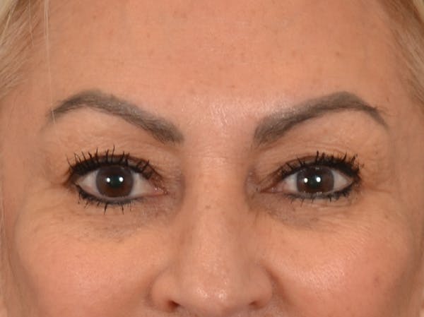 Eyelid Lift Before & After Gallery - Patient 430420 - Image 1