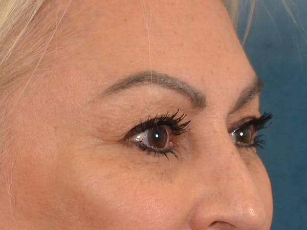 Eyelid Lift Before & After Gallery - Patient 430420 - Image 3